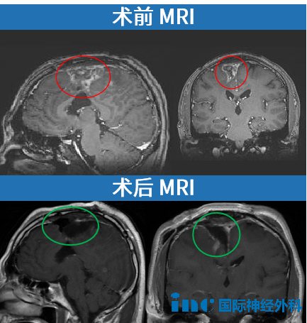 術(shù)前術(shù)后MRI