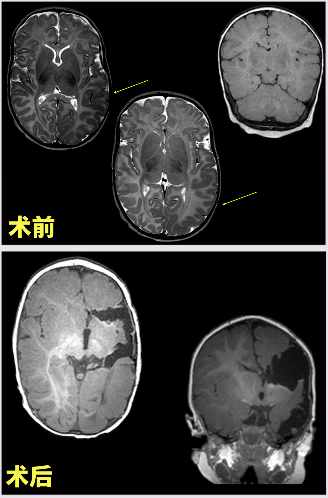 術(shù)前術(shù)后MRI