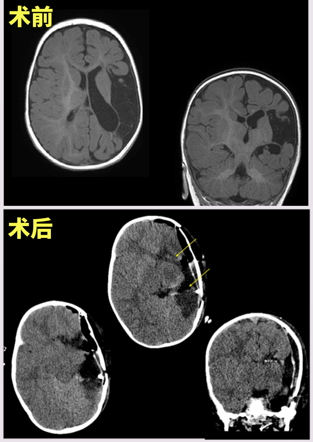  癲癇發(fā)作致大腦中動(dòng)脈梗死
