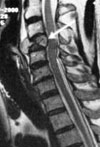 磁共振成像(MRI)結(jié)果顯示了脊髓受到壓迫的現(xiàn)象。