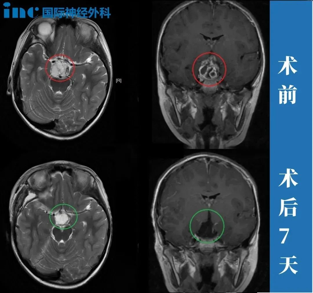 7歲男孩-顱咽管瘤