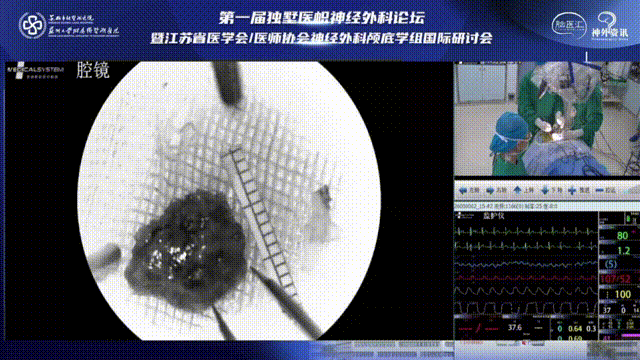 ▼直播情況：腫瘤取出畫(huà)面