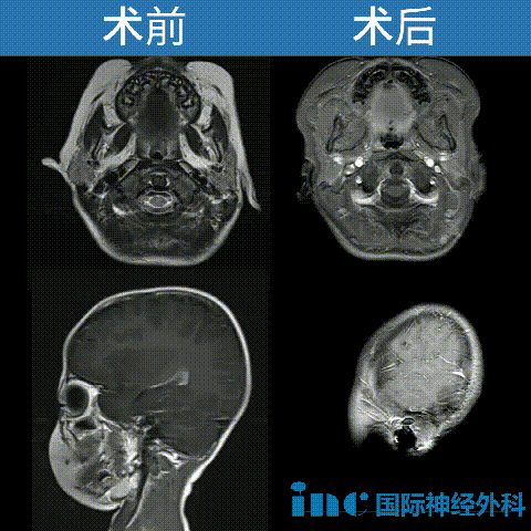 3歲男孩-巨大腦干膠質(zhì)瘤