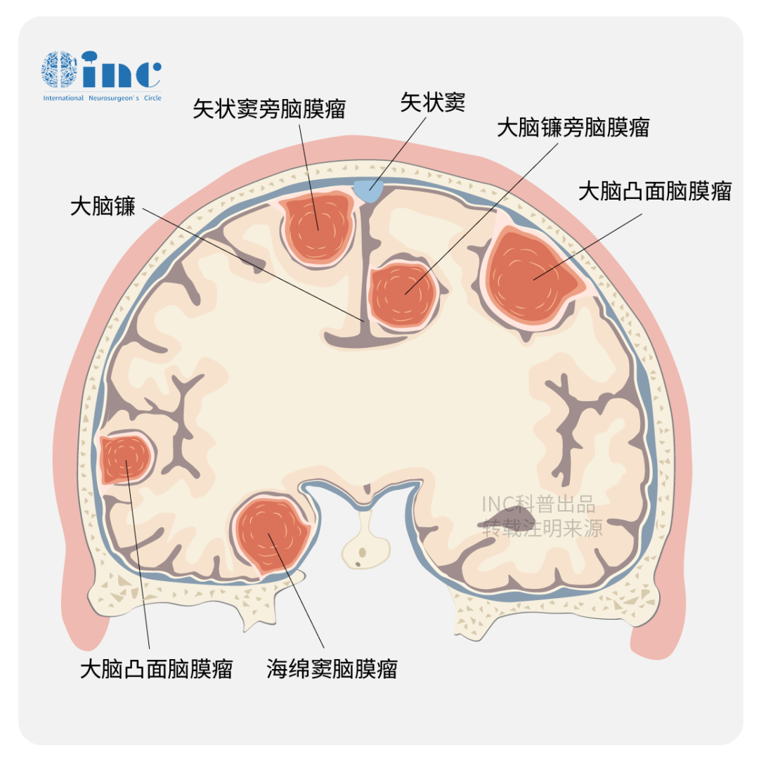 腦膜瘤