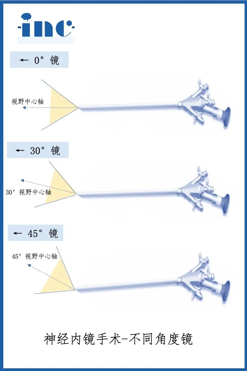 內(nèi)鏡鏡體的視角有多種，包括0°、30°、45°、70°、120°等。不同視角的神經(jīng)內(nèi)鏡適用于不同的手術(shù)場合。通常，0°、30°、45°的鏡體角度用于手術(shù)操作和觀察，而70°和120°的鏡體角度則主要用于觀察目的。
