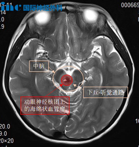 INC巴教授主刀、國(guó)內(nèi)神經(jīng)外科醫(yī)生團(tuán)隊(duì)全力配合下，突破“生命禁區(qū)”，為她順利示范手術(shù)。