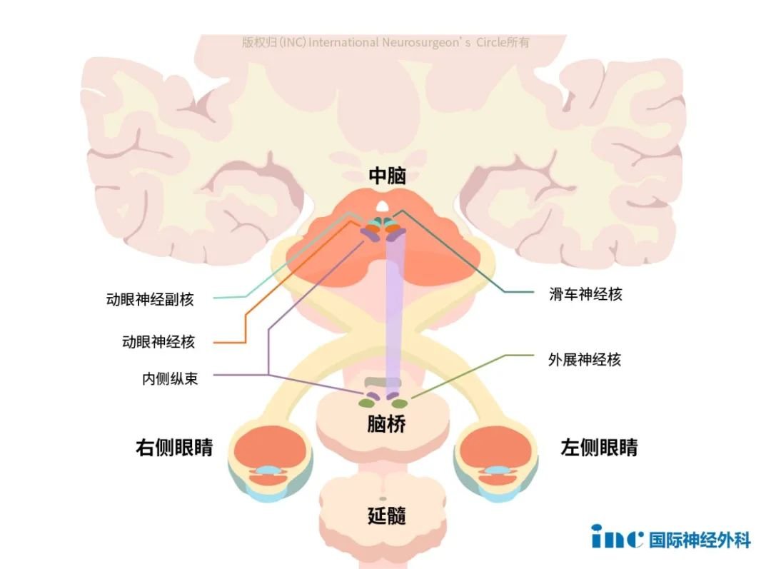 INC巴教授主刀、國(guó)內(nèi)神經(jīng)外科醫(yī)生團(tuán)隊(duì)全力配合下，突破“生命禁區(qū)”，為她順利示范手術(shù)。