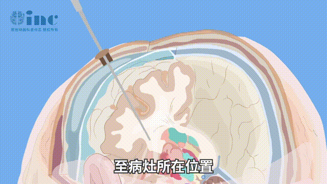 LITT在顱內(nèi)疾病的治療中越來越受到歡迎，包括兒童神經(jīng)腫瘤和癲癇。