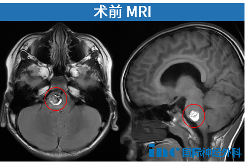 術(shù)前MRI影像
