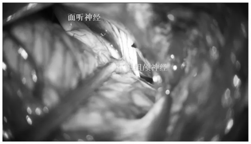 充分顯露后組顱神經(jīng)、面聽神經(jīng)及絨球