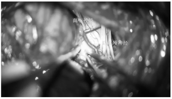 于面聽神經(jīng)根部及后組顱神經(jīng)根部間造瘺，此處神經(jīng)探頭刺激陰性(牽開絨球)