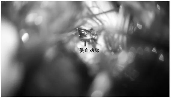 斷除畸形血管團(tuán)供血?jiǎng)用}