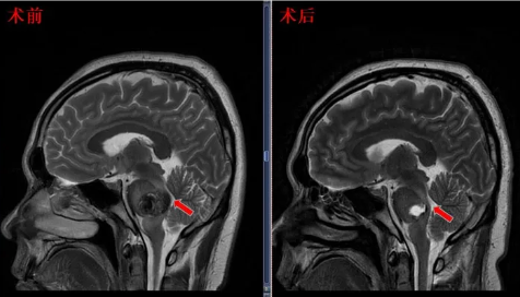 術(shù)后患者M(jìn)RI顯示面丘結(jié)構(gòu)恢復(fù)