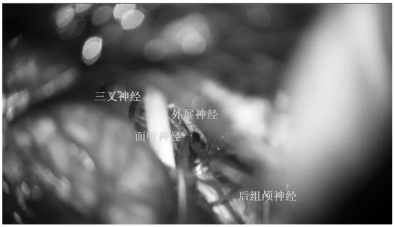 三叉神經(jīng)、面聽神經(jīng)、外展神經(jīng)、后組神經(jīng)保護(hù)完好