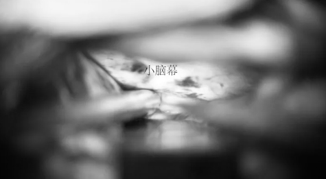 牽開顳葉暴露小腦膜