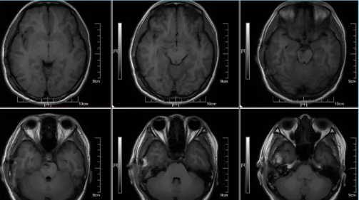 術(shù)后48h MRI T1W1