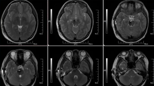 術(shù)后48h MRI T2W1