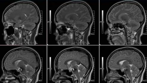 術(shù)后24內(nèi) MRI T2W1