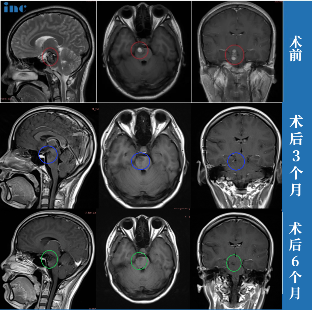 術(shù)前術(shù)后MRI對比