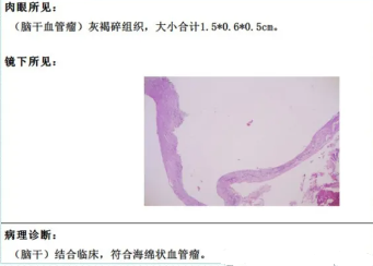 術(shù)后病理：腦干海綿狀血管瘤