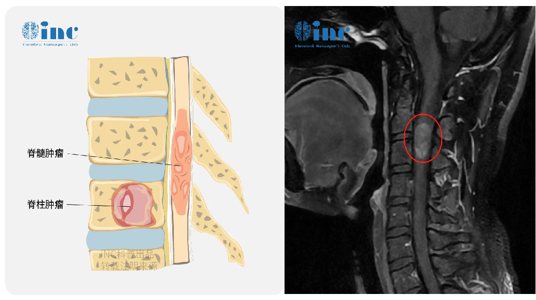 瀟瀟的脊髓MRI