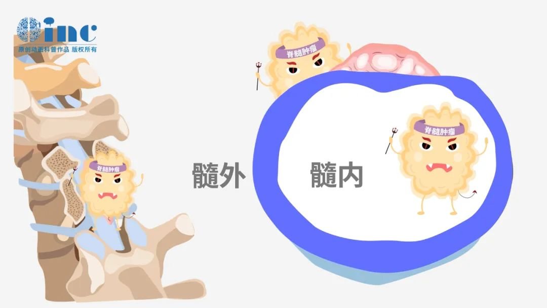 腫瘤