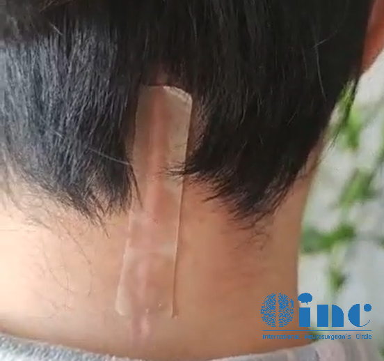 經(jīng)歷了脊髓髓內(nèi)室管膜瘤全切術(shù)后的她狀態(tài)良好，看起來(lái)幾乎和常人無(wú)異，后腦勺那條細(xì)細(xì)的刀口被美麗的秀發(fā)覆蓋著，別人都想象不到她曾經(jīng)歷過(guò)一場(chǎng)高難度的開(kāi)顱手術(shù)。