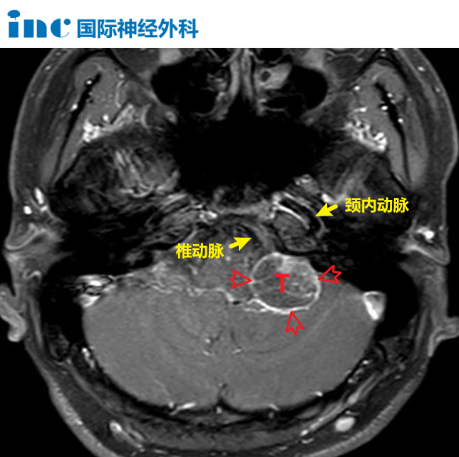 頸靜脈孔