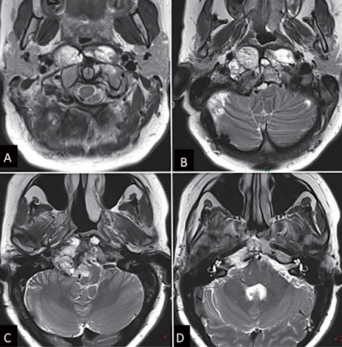 內(nèi)鏡下鼻內(nèi)鏡入路前的術(shù)前影像。(A - D) MRI T2 WI顯示一個(gè)巨大脊索瘤延伸至椎前間隙和齒狀突周圍。腫瘤橫向延伸至舌下管和頸靜脈孔，并向內(nèi)側(cè)延伸至硬膜內(nèi)間隙。腫瘤從斜坡中部延伸至樞椎齒狀突周圍。