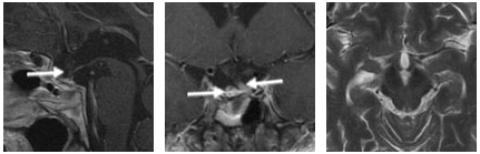 患者術(shù)后磁共振成像(MRI)影像