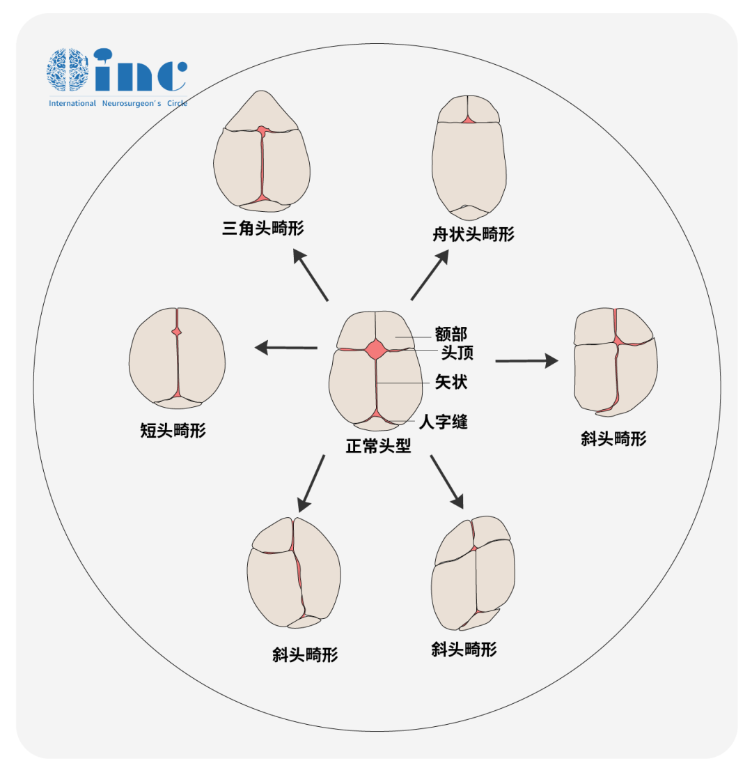 顱縫早閉的早期發(fā)現(xiàn)主要基于異常頭型的主觀識別
