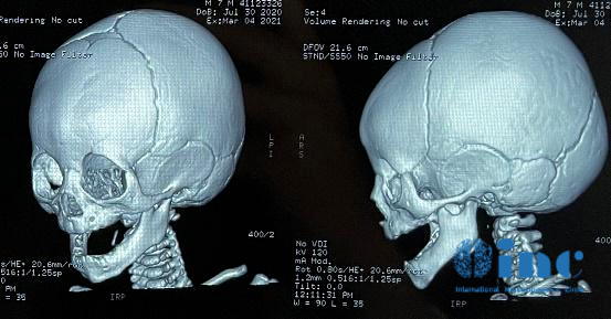 重點1：該兒童頭骨的 CT 掃描顯示正中額骨嵴和額縫閉合，并伴有輕微的前額變形，并沒有典型的移位和額突(這是額縫早閉的典型特征)。