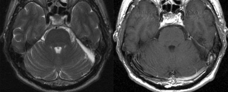 術(shù)后 MRI 圖像顯示腫瘤已完全切除