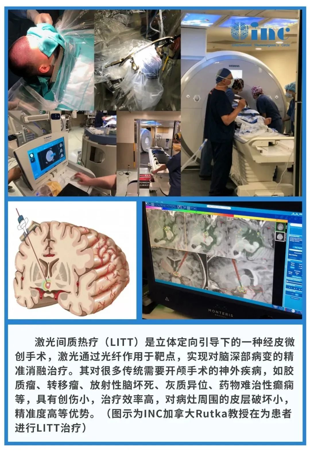 LITT 的安全性可以為兒童提供一種有吸引力的開顱手術(shù)替代方案。