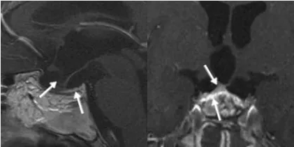 術(shù)后進行的磁共振成像（MRI）隨訪檢查表明腫瘤已被完全切除，同時顯示剩余的垂體腺明顯萎縮但仍保持完整。