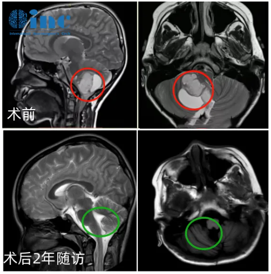 術(shù)后兩年隨訪影像