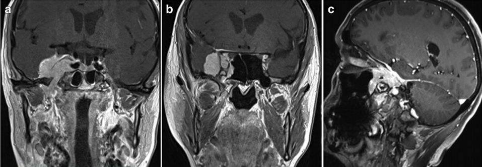 該患者術(shù)前磁共振成像（MRI）圖像。在其右側(cè)海綿竇區(qū)有一病變，且向顳窩、蝶鞍上區(qū)（SOF）、翼腭窩（FR）、眶上裂（FO）、翼腭縫（PPF）、巖斜區(qū)（ITF）及蝶鞍區(qū)（SphS）擴(kuò)展。  