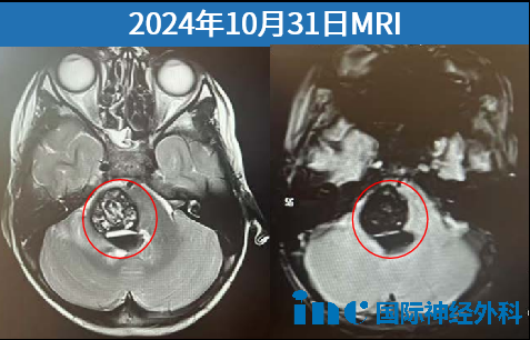 大出血伴隨病灶周圍壓力劇增與水腫蔓延，水腫自延髓迅速擴展至中腦。