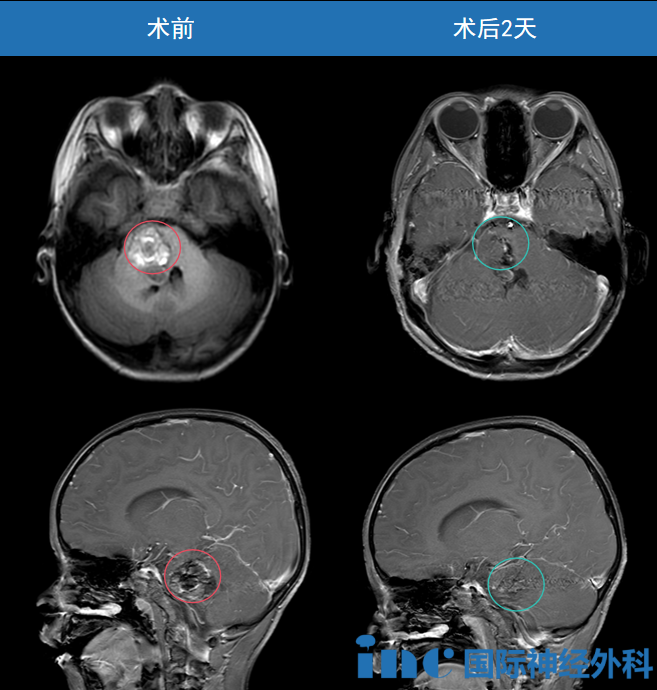 這顆巨大的腦干海綿狀血管瘤被順利全切。