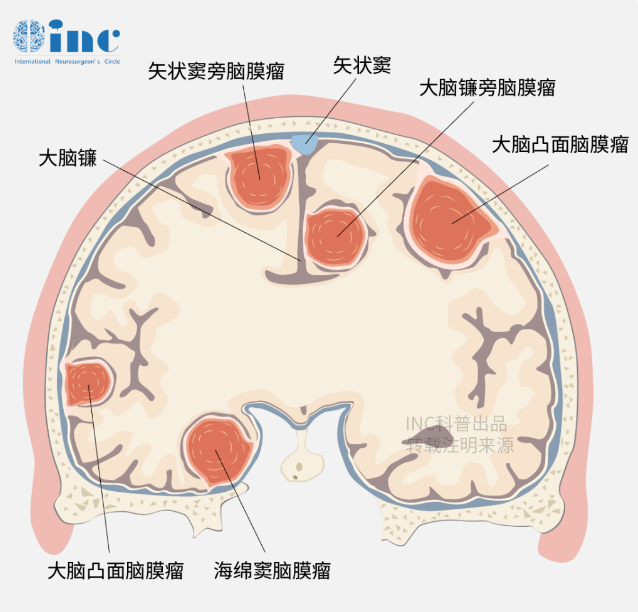 嗅溝腦膜瘤