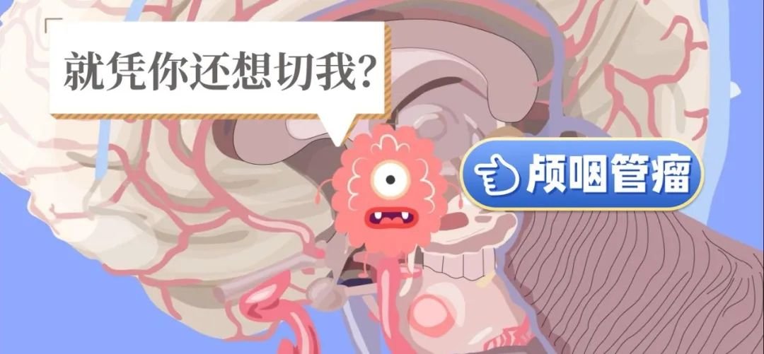 盡全切+保功能「雙保險(xiǎn)」顱咽管瘤手術(shù)才能安全下車！巴教授天壇醫(yī)院手術(shù)紀(jì)實(shí)