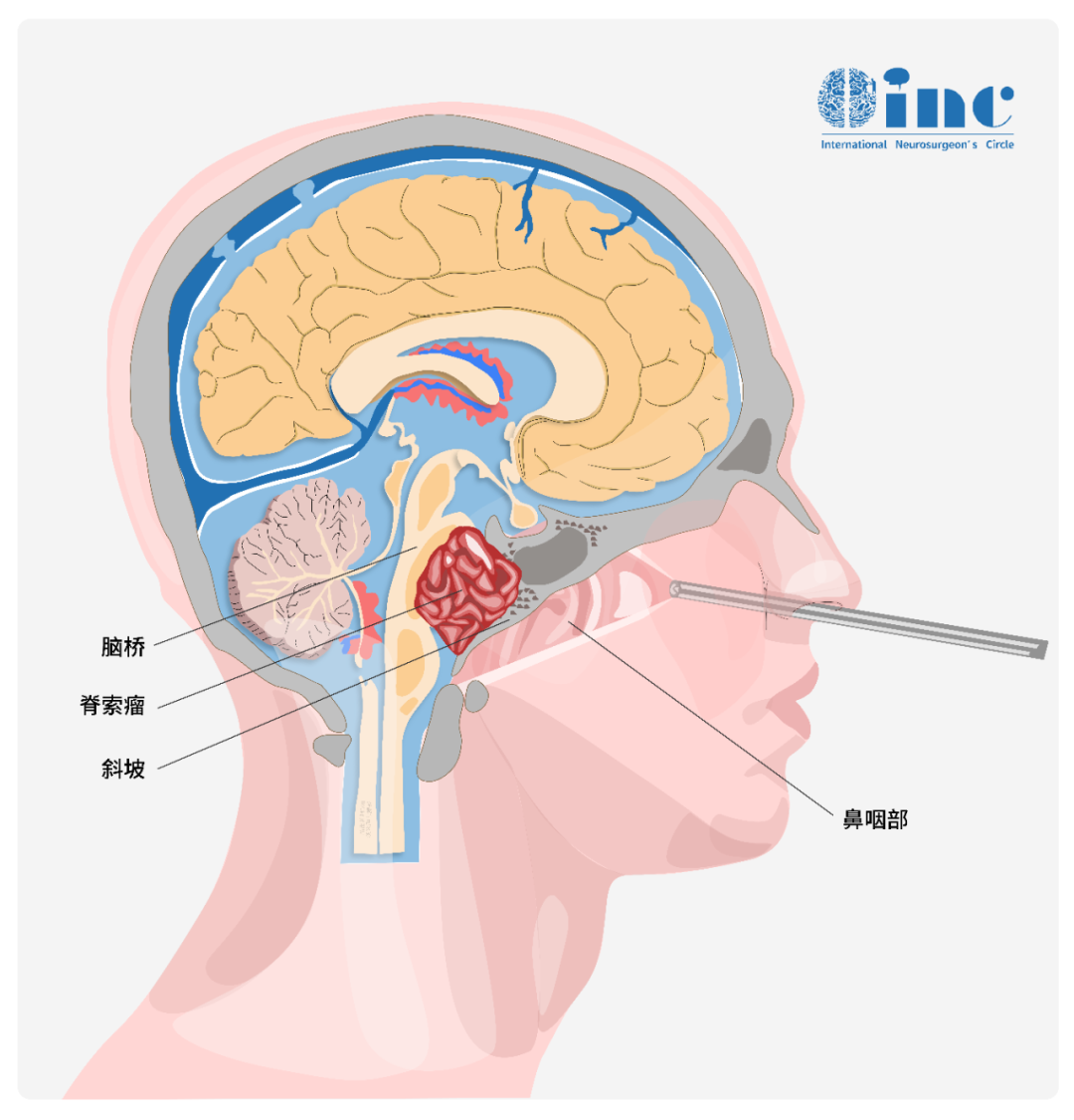 斜坡是顱底的一個(gè)重要解剖區(qū)域，它包含多個(gè)關(guān)鍵的神經(jīng)組織和結(jié)構(gòu)，包括：
