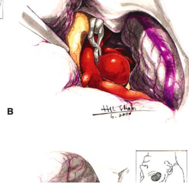 首先，對于未破裂動脈瘤，尤其是高風險位置（如大腦中動脈分叉處），夾閉可以很好地避免出血的可能；而對于已破裂動脈瘤，夾閉也能快速止血并減少再出血風險。