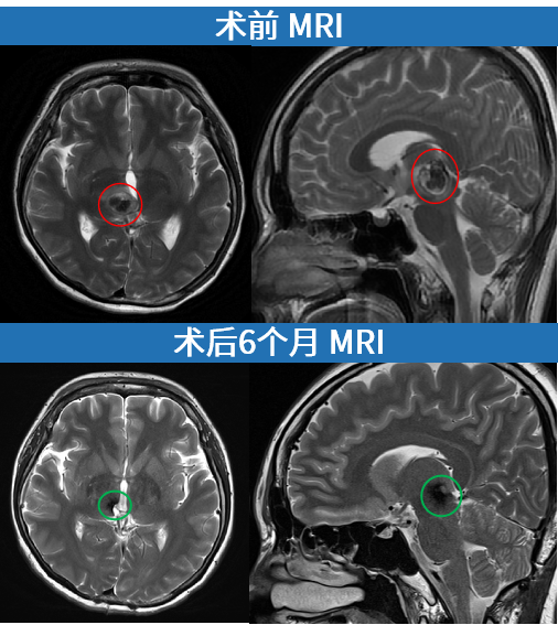 30歲女性-丘腦中腦海綿狀血管瘤