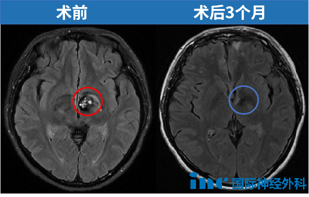33歲女性-丘腦基底節(jié)海綿狀血管瘤