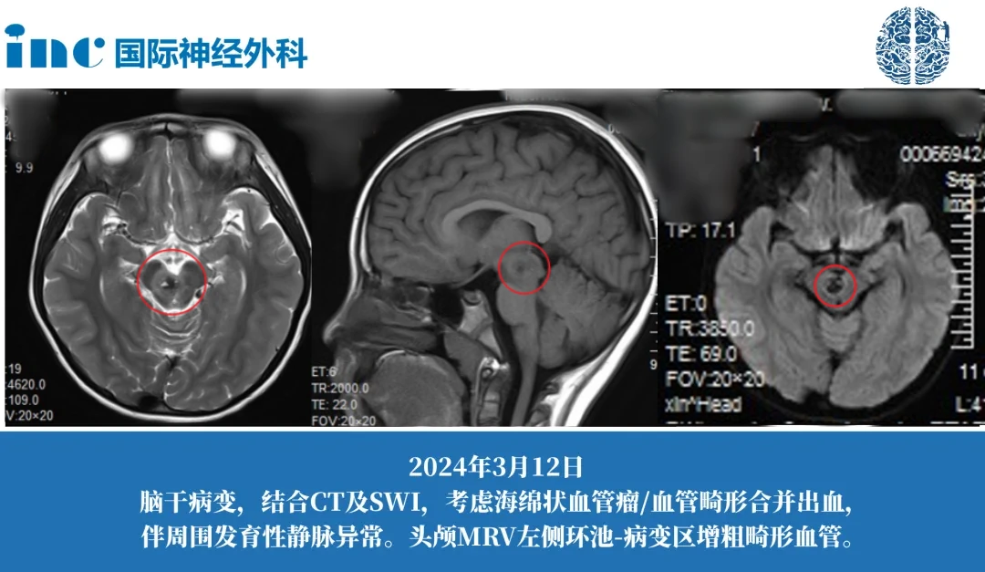 腫瘤影響了動眼神經(jīng)核，這是控制眼球運動的關鍵區(qū)域。受腫瘤影響，果果出現(xiàn)了嚴重的動眼神經(jīng)麻痹，導致她的一只眼睛無法正常開閉，并且瞳孔異常擴大。醫(yī)生們提示，手術(shù)中如果動眼神經(jīng)核受到進一步損傷，可能會導致果果的視力永久受損。