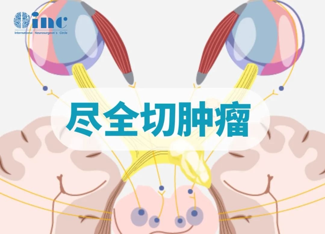 INC國際大咖經(jīng)蝶竇手術(shù)讓垂體大腺瘤無處可逃