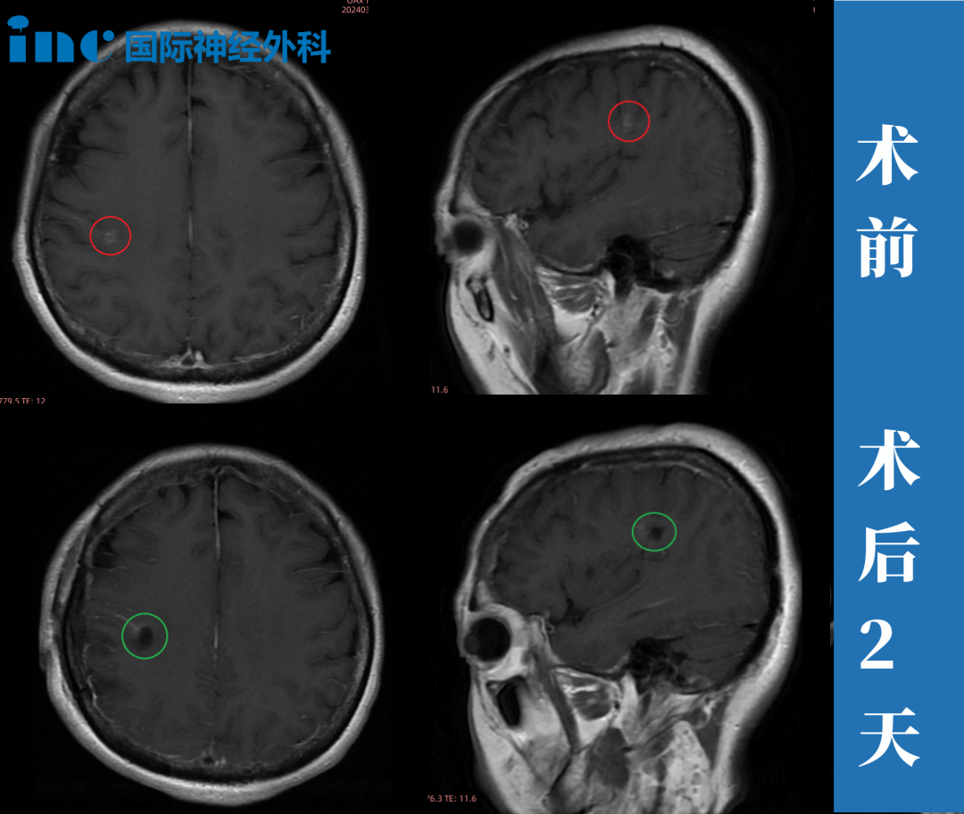 術(shù)前術(shù)后mri
