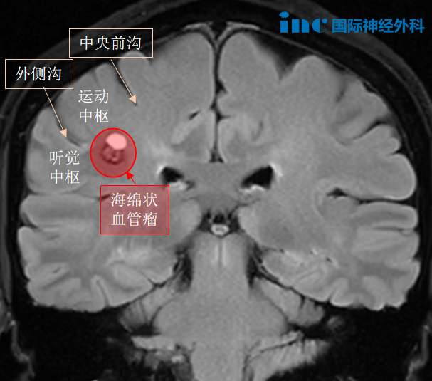 ▲圖示：鄧女士的海綿狀血管瘤位于一個巨大腦溝的底部，位于中央后溝。腦功能區(qū)的海綿狀血管瘤 ，常引起癲癇 、出血和局部神經(jīng)功能缺失，手術(shù)切除病灶是根本的治療方法。