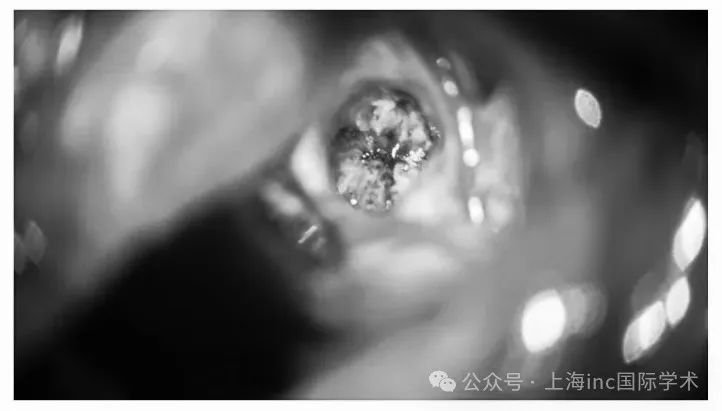 瘤腔止血徹底，血管瘤完整切除